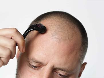MICRONEEDLING
